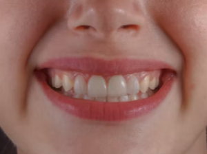 이가 나는 꿈 해몽